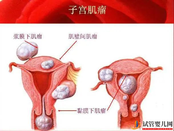 试管婴儿网:子宫肌瘤会影响试管婴儿成功率吗？(图1)