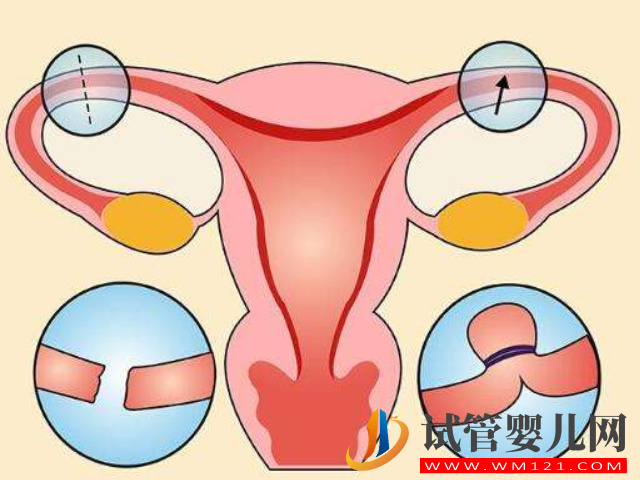 慢性盆腔炎会引起宫外孕
