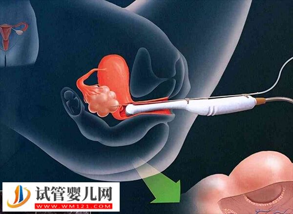 做人工授精有哪些缺点(图1)